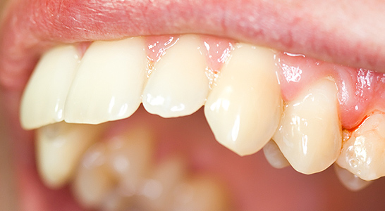 periodontitis gingivitis dental internacional
