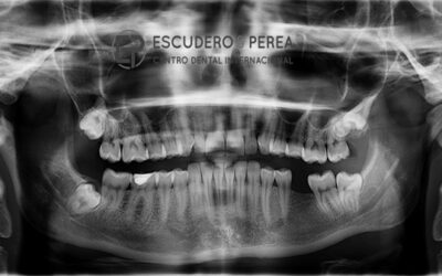 He perdido dos muelas hace  años ¿me pueden colocar  un implante dental en los espacios de las muelas perdidas?