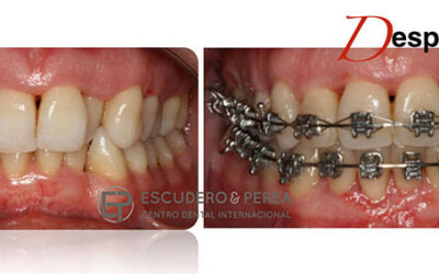 ¿Puedo llevar ortodoncia si tengo periodontitis?