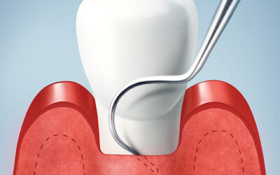 ¿Qué es el raspado y alisado radicular? Comúnmente e incorrectamente llamado «curetaje dental»