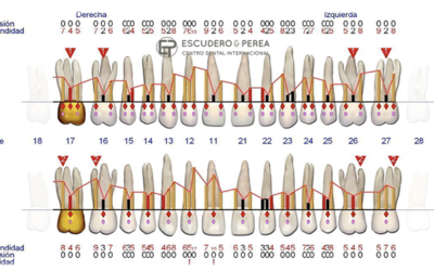 ¿Que pasa si mi caso periodontal es muy avanzado?