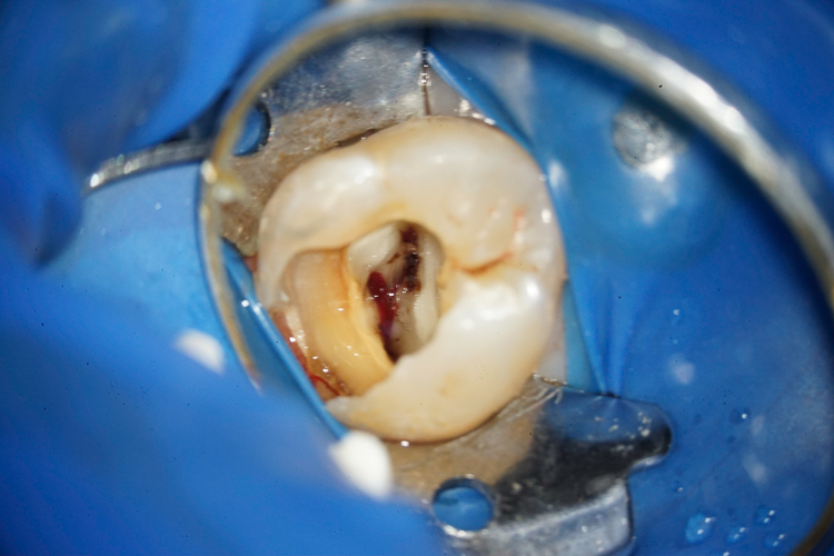 Hay vida para tus dientes antes que el implante dental
