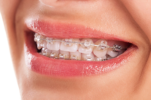 ¿Me pueden hacer un tratamiento de ortodoncia si llevo implantes dentales?