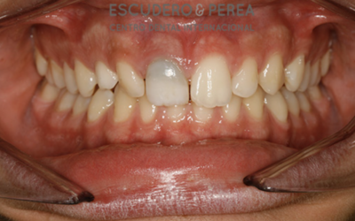 ¿Que es un blanqueamiento dental interno?