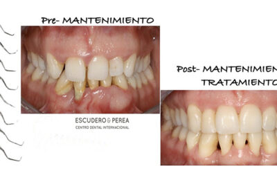 ¿Que es el mantenimiento periodontal?