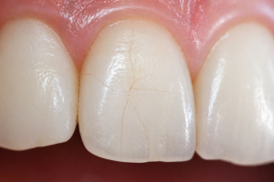 Que es una fisura dental